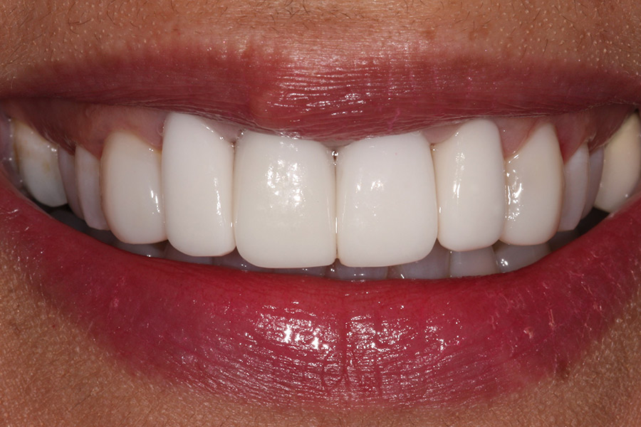 Ceramic anterior crowns with BioClear composite veneers on the canine teeth