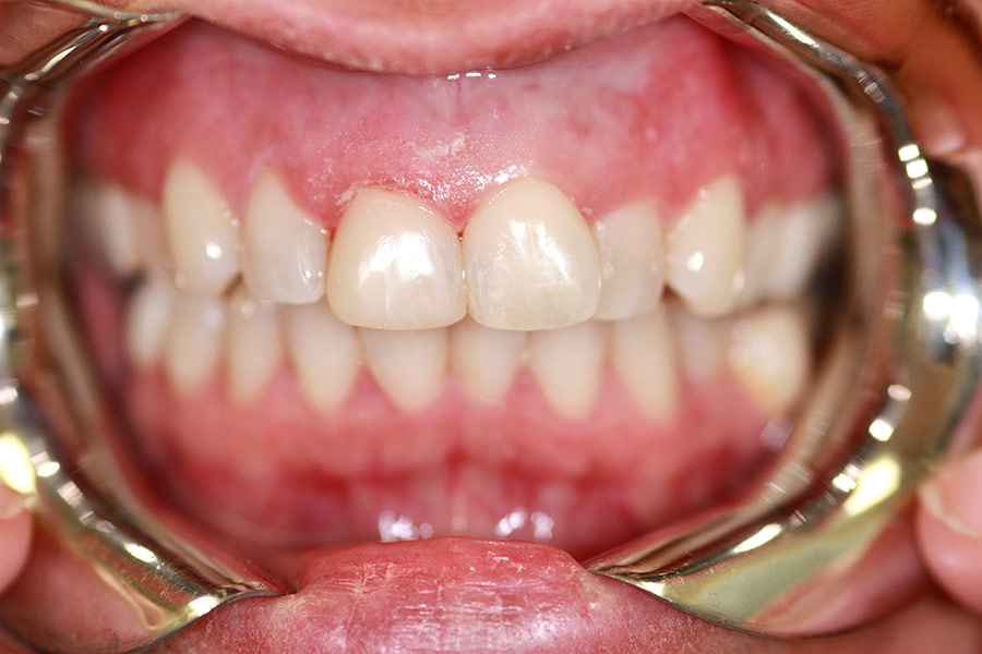 Composite resin on broken tooth bonding