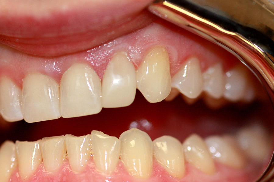 Full mouth whitening, resin veneer single tooth Chairside Venee Cosmetic recontouring of anterior 6 teeth