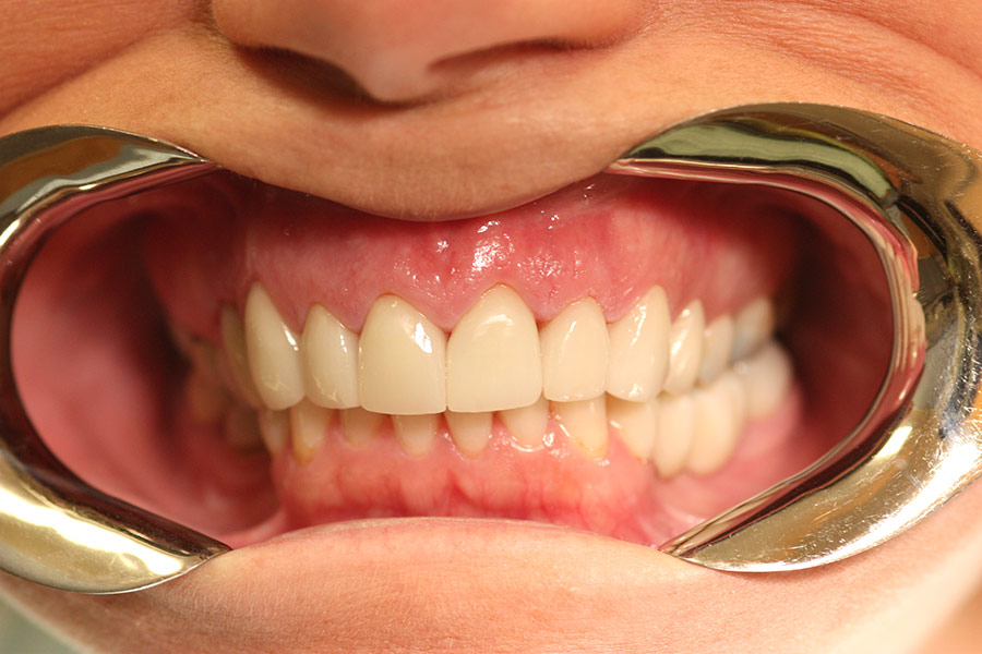 Old unsightly veneers replaced with all ceramic crowns