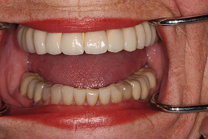 Porcelain to Gold Bridge Whitened lower teeth