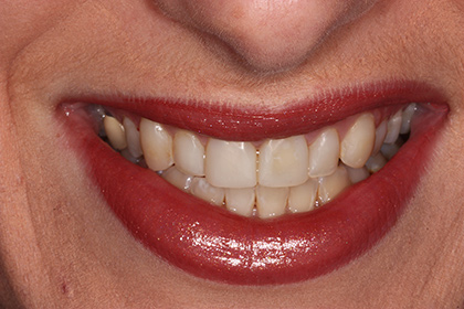 Composite done on anterior teeth