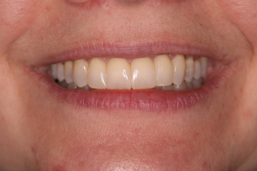 bioclear after