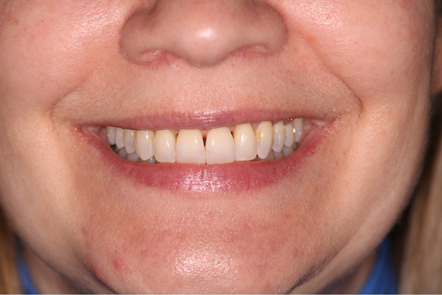 bioclear before
