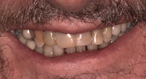 Crown and bridge procedure