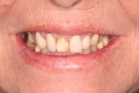 crown and bridge procedure