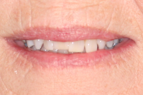 crown and bridge procedure