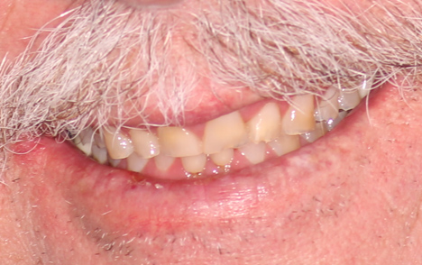 Full mouth procedure