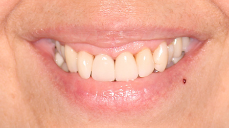 veneers