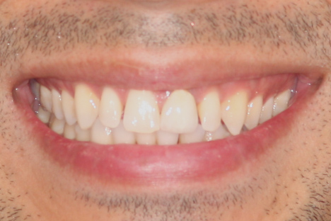 veneers