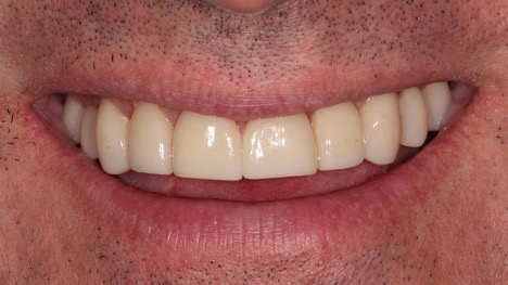 veneers after