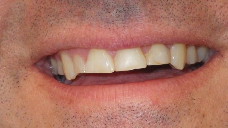 veneers befroe
