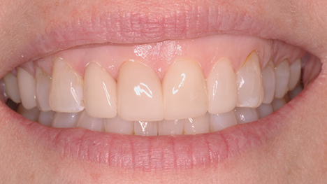 veneers after