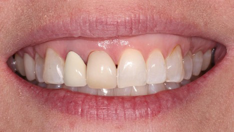 veneers before