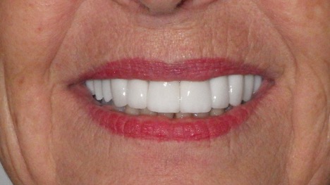 veneers after