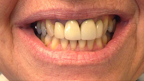veneers before